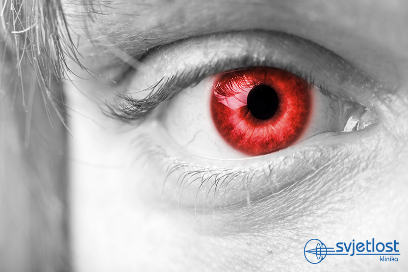 Ali veste, kateri je medicinski pomen „ efekta rdečih oči“ na fotografijah?