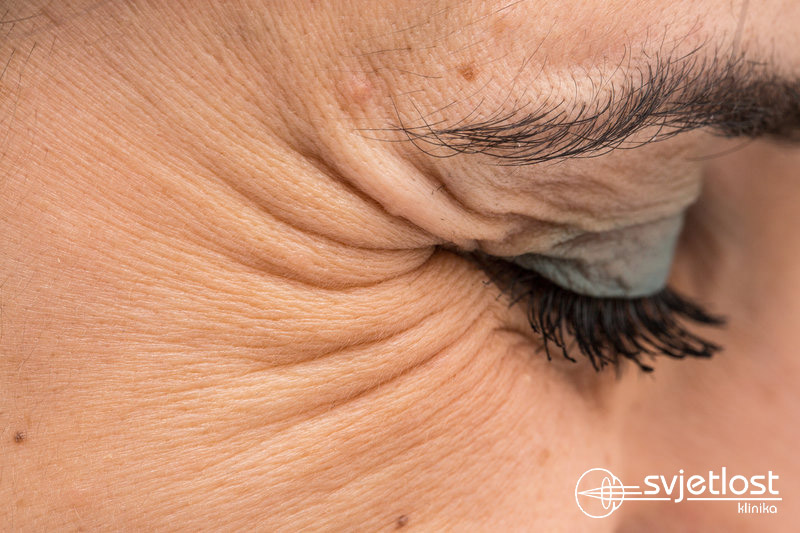 Jeste li znali da je prvi znak starenja pojava bora oko očiju?